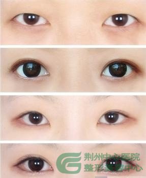 宜昌哪里做双眼皮好