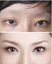 开眼角术后多久可以拆线？